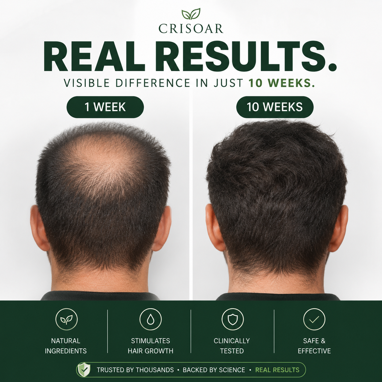 Crisoar Microneedle Infusion Kit — Fuller Hair Starts at the Root